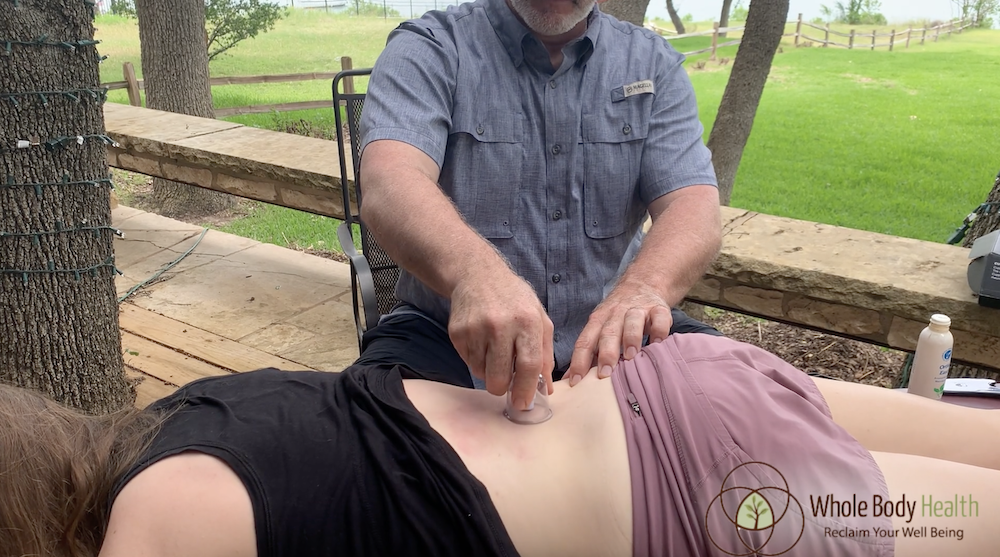Cupping Therapy for the Lower Back