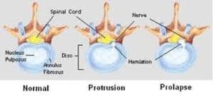 Disc Herniation